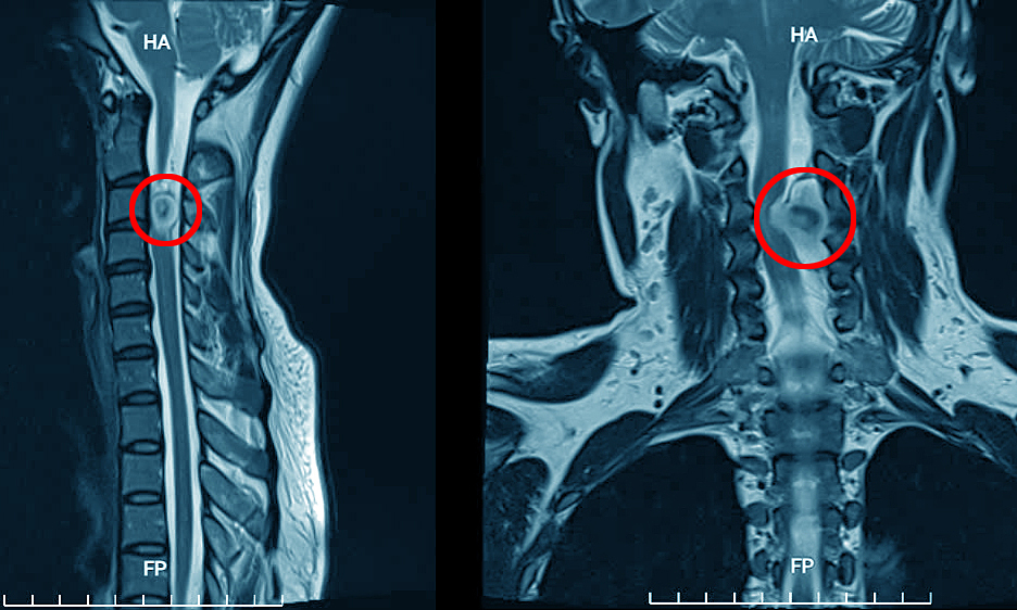 Tưởng đau cổ vai gáy hóa khối u chèn ép tủy