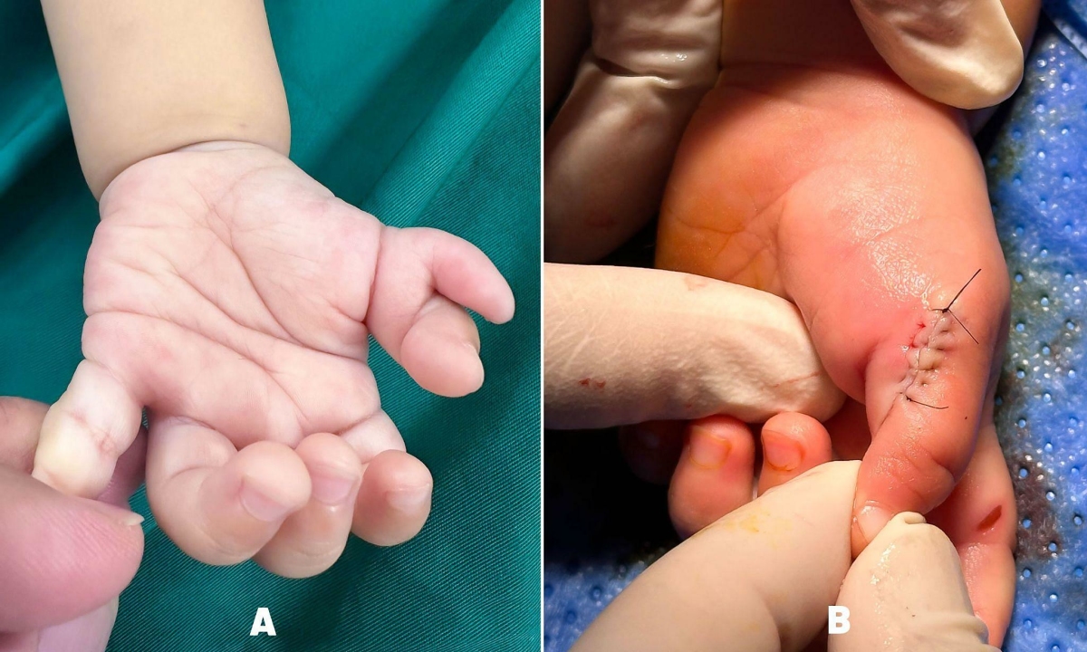 Trẻ dị tật thừa ngón nên phẫu thuật trước một tuổi