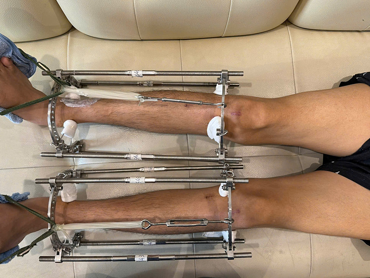 Cơn đau 'đến tận xương tủy' sau kéo dài 8 cm chân