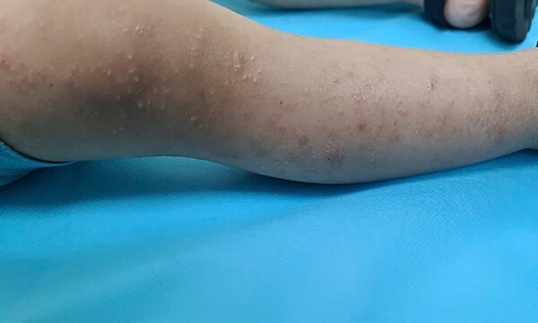 Bé trai bị viêm mô tế bào do viêm da cơ địa