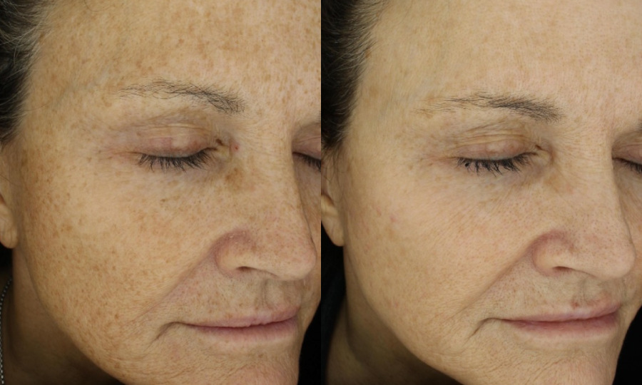 Laser DermaV - giải pháp trị sắc tố và mạch máu