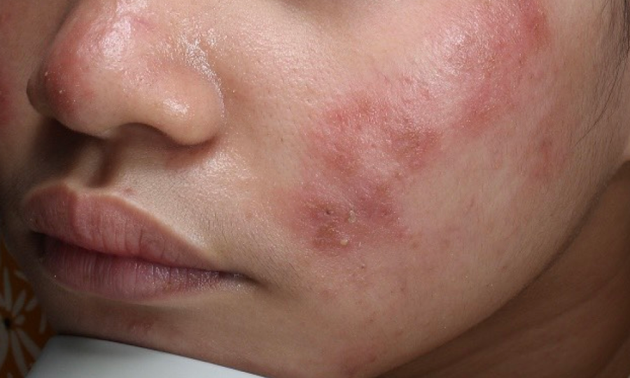 Viêm da tiết bã có trị dứt điểm không