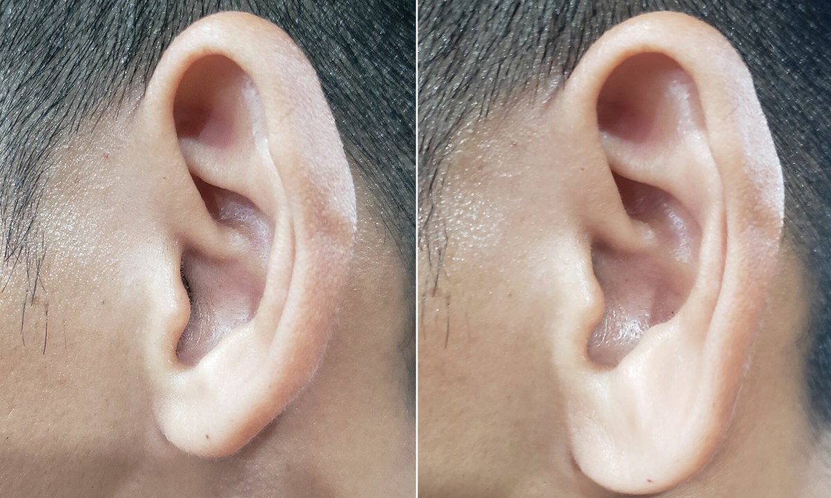 Có nên tiêm tai tài lộc?