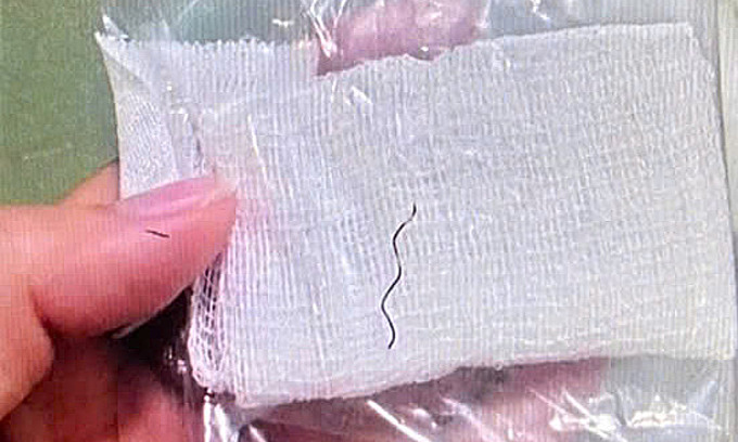 Tưởng hóc xương cá hóa sợi kim loại ở thực quản