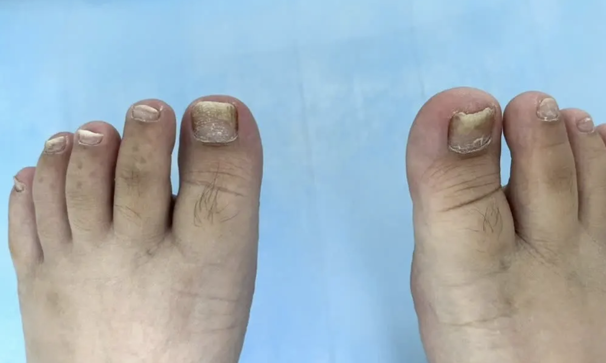 Phòng tránh bùng phát vảy nến dịp Tết