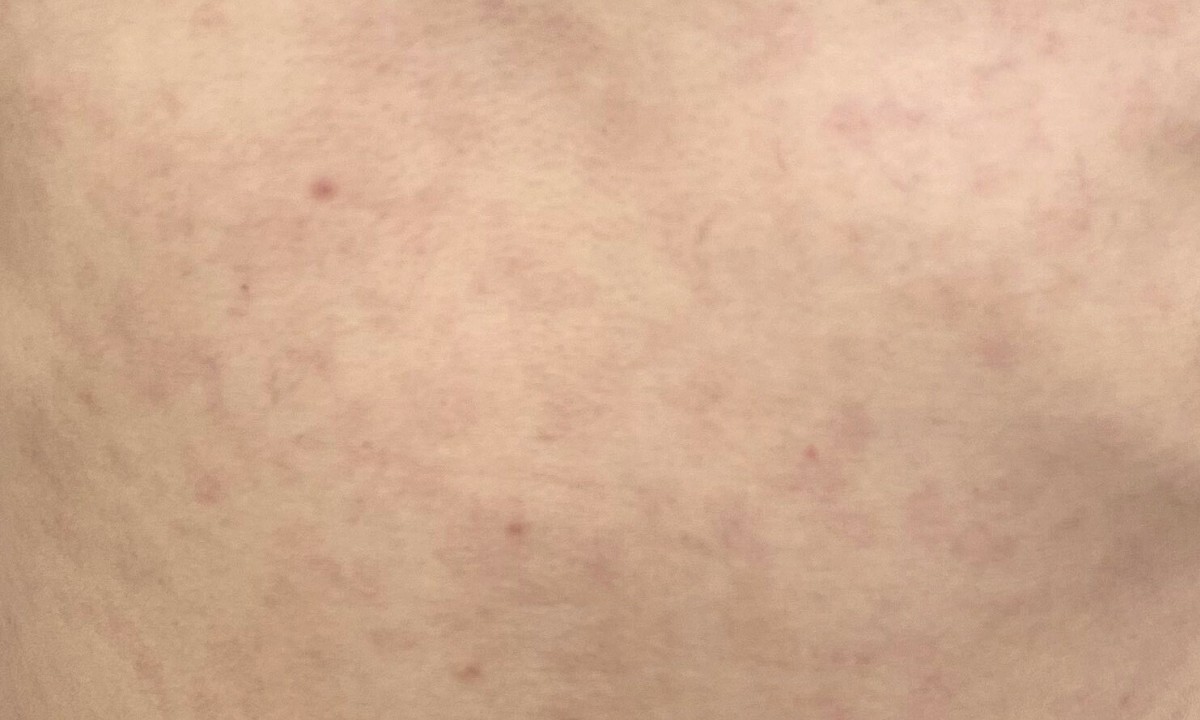 Nổi ban đỏ có phải giang mai không?
