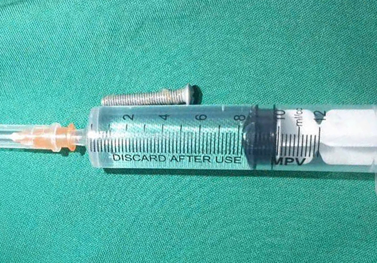 Bé trai nuốt đinh vít dài 5 cm