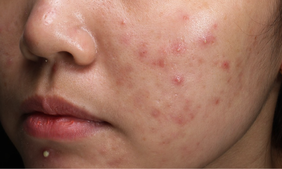 Mụn kháng trị - vấn đề da liễu phức tạp