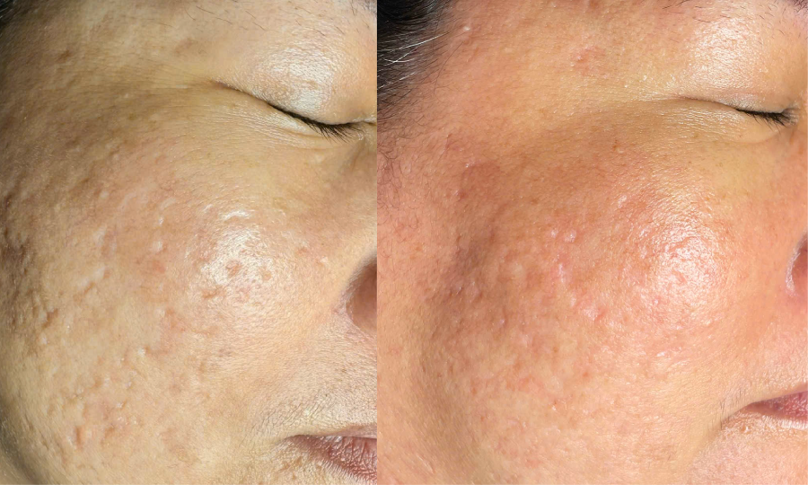 Bốn bước xử lý sẹo lão hóa với Mezoclear