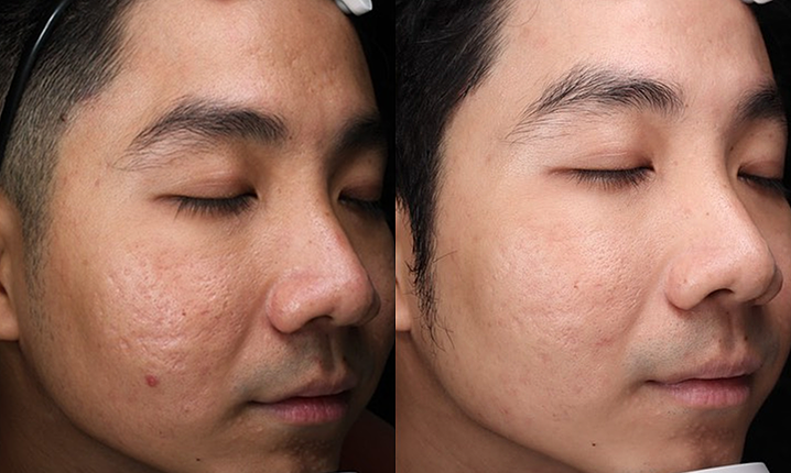 Điều cần biết về sẹo do mụn trứng cá