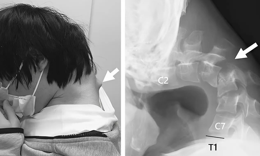 Biến dạng cột sống cổ vì chơi điện thoại