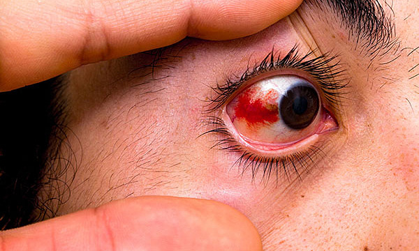 Hôn mê, vỡ mạch máu mắt vì thói quen ăn uống thiếu lành mạnh