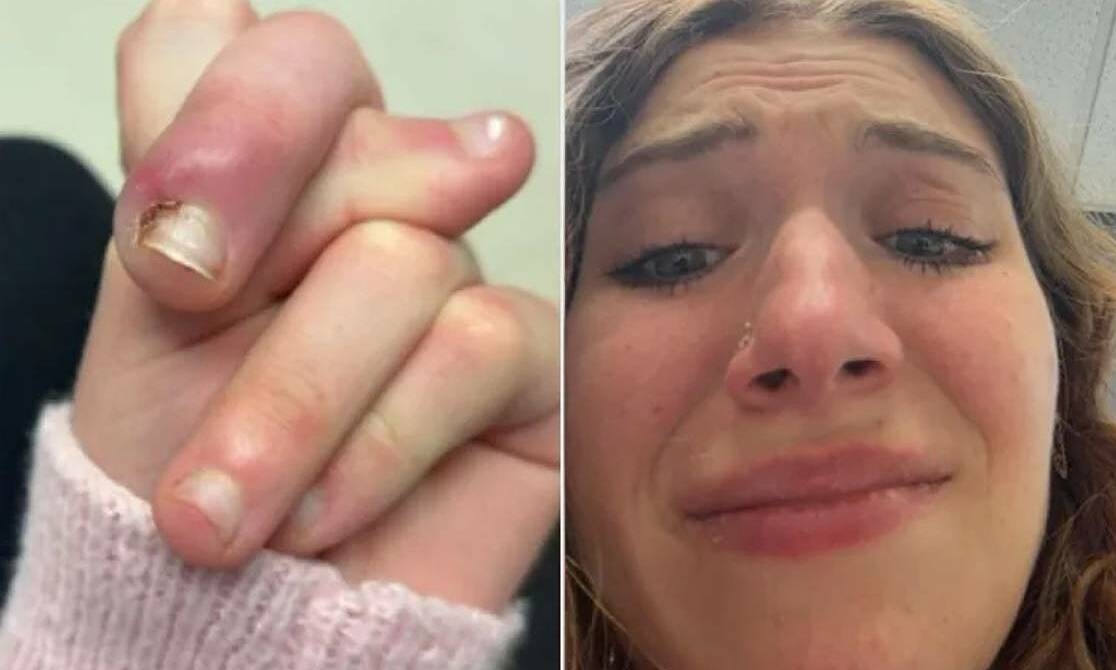 Suýt mất ngón vì thói quen cắn móng tay